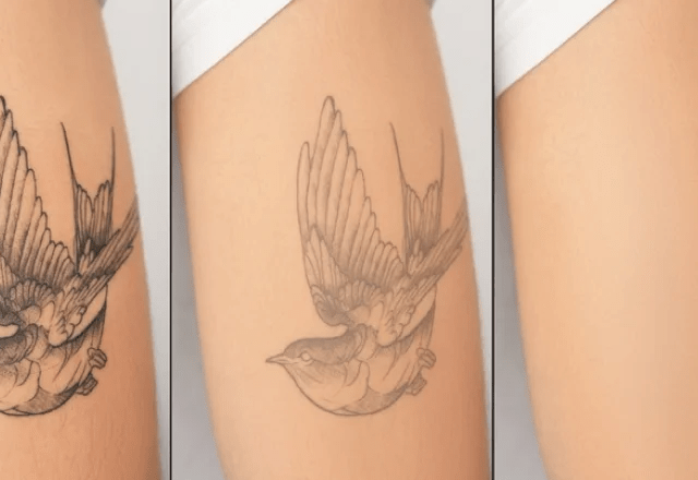 tattoo removal near me
