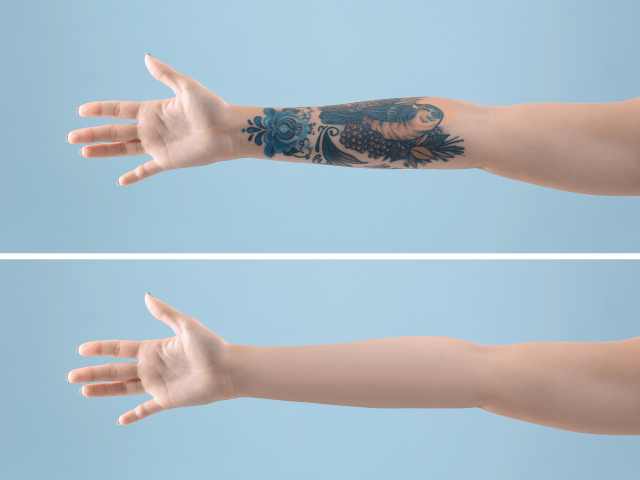 tattoo removal near me