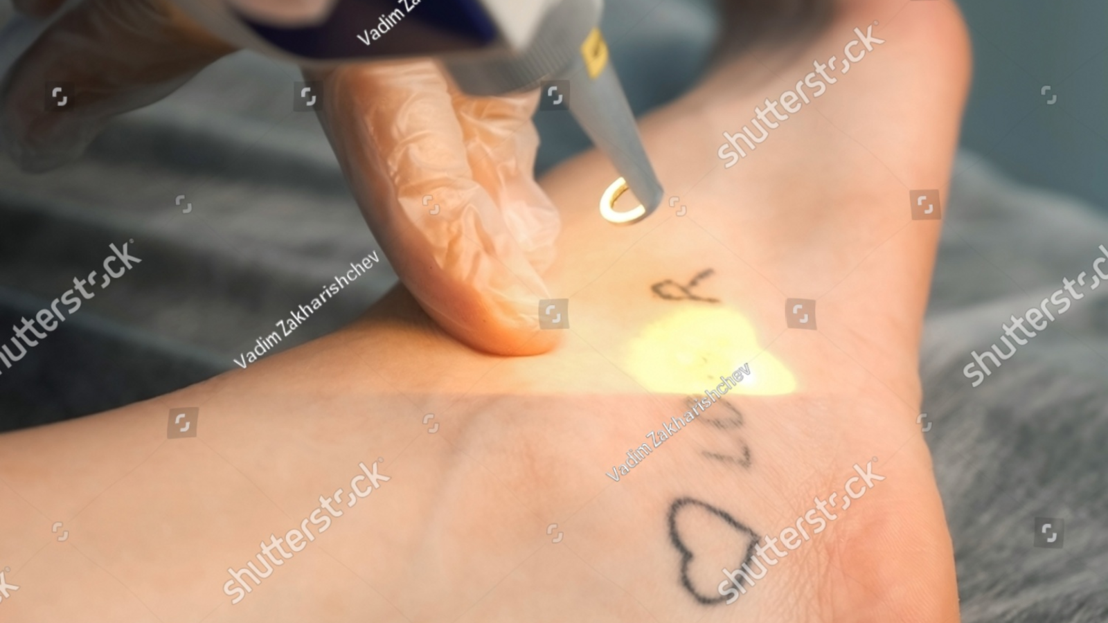 tattoo removal cost